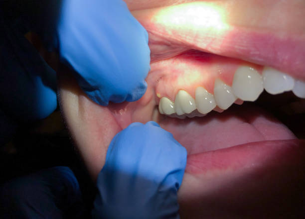 Best Emergency Dentist for Knocked-Out Tooth in San Diego Country Estates, CA