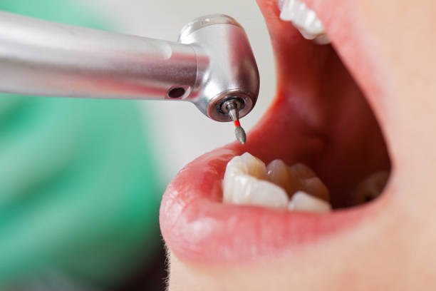 Best Emergency Dentist for Lost Fillings or Crowns in San Diego Country Estates, CA
